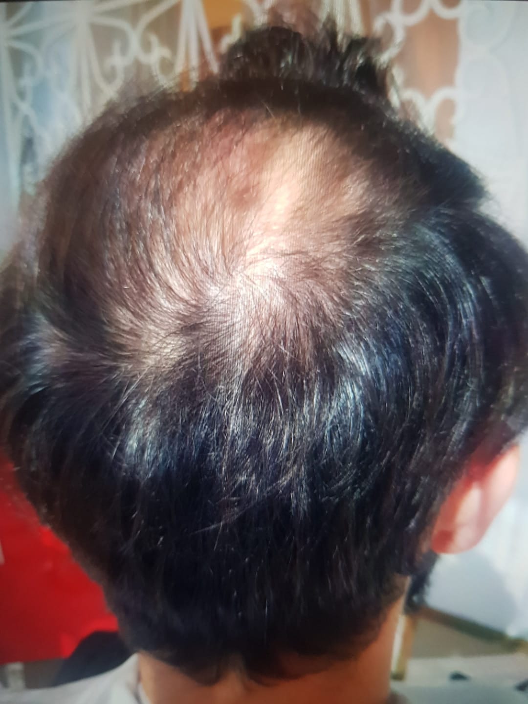 Antes — prótese capilar cliente 1