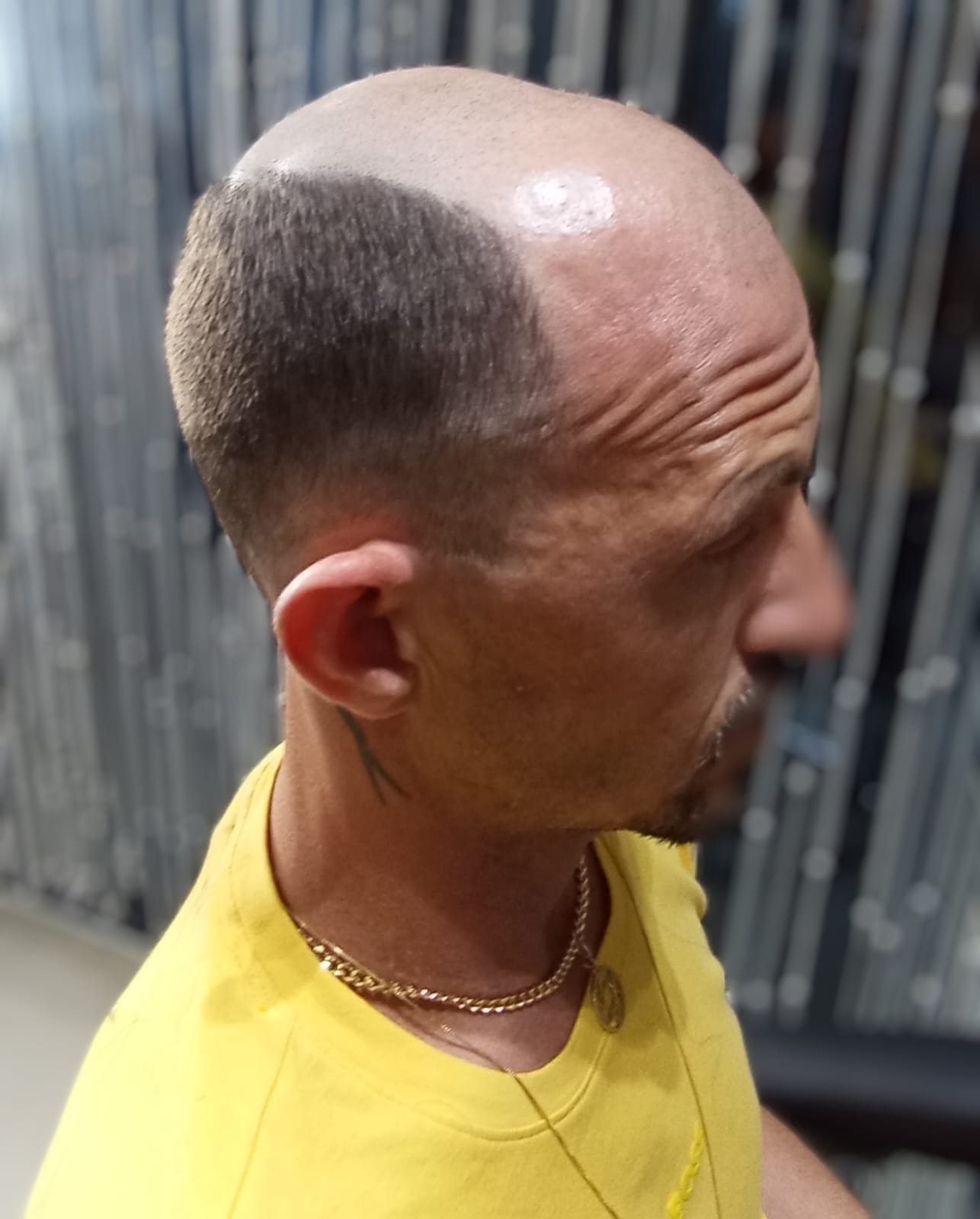 Antes — prótese capilar cliente 3