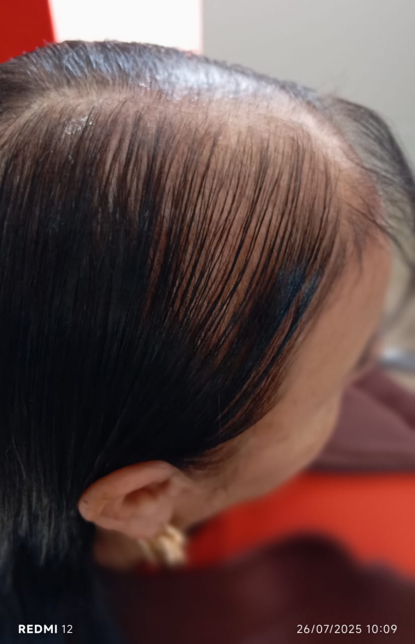 Prótese feminina antes 2