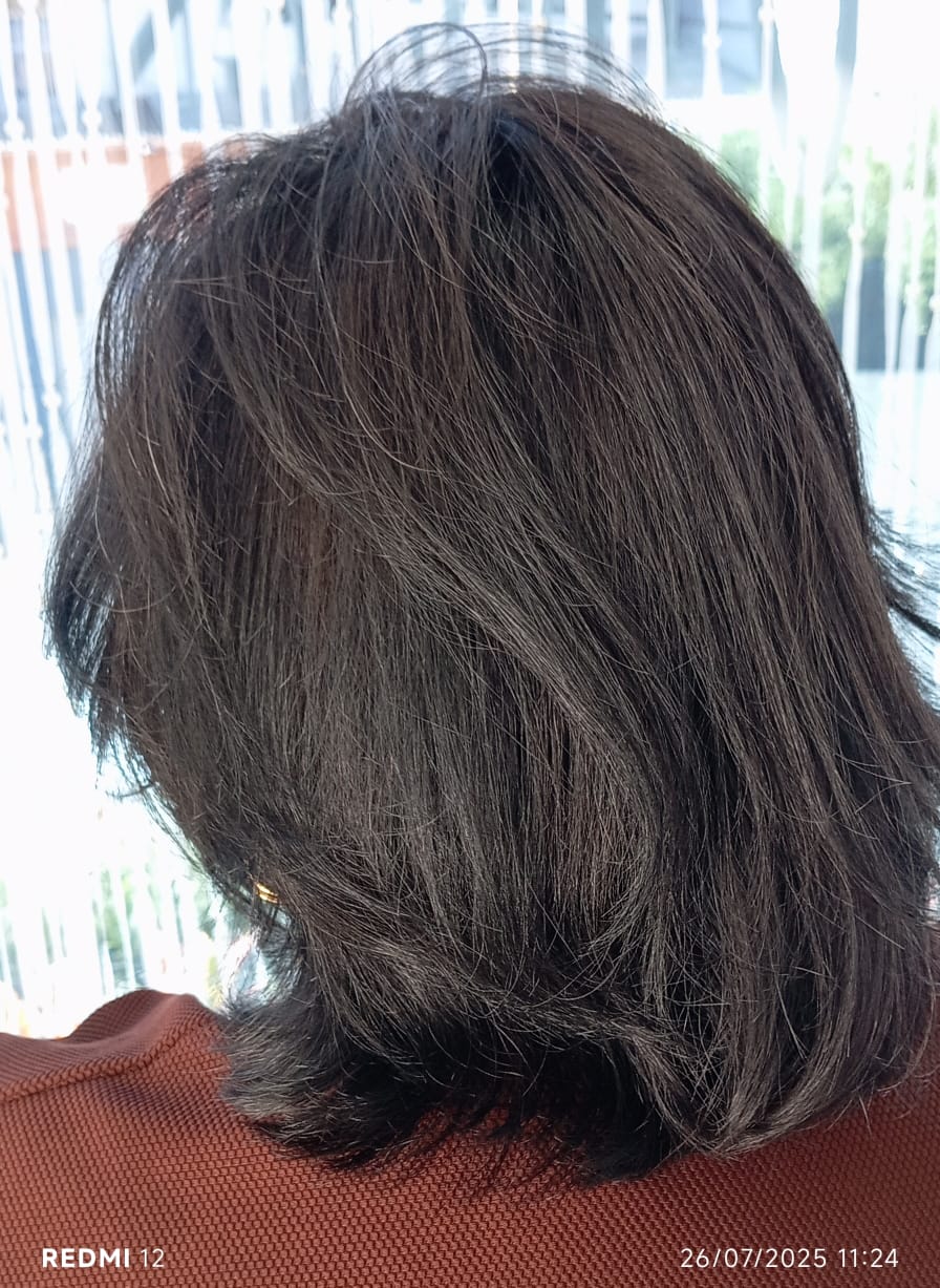 Prótese feminina depois 2